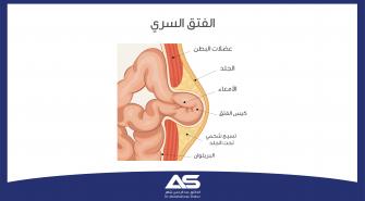 ما هو الفتق السُري؟