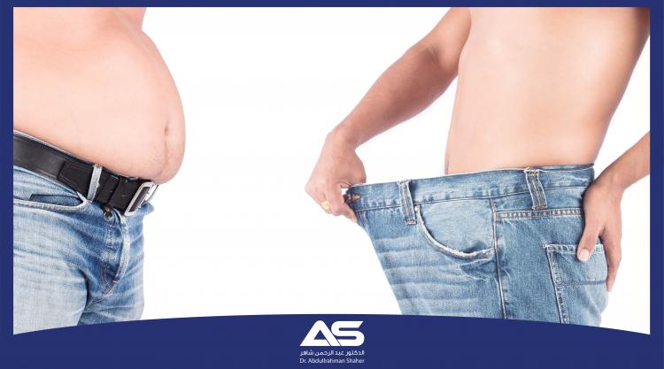 جراحة تحويل المسار المصغّرة Mini Gastric Bypass  إيجابياتها، سلبياتها، ومخاطرها