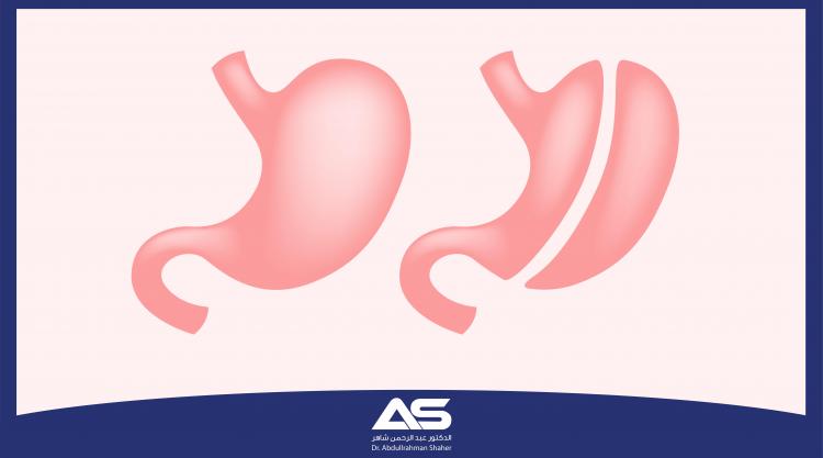 توصيات ونصائح حول عملية تكميم المعدة  Sleeve Gastrectomy
