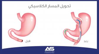 جراحة تحويل المسار الكلاسيكية Roux-en-Y  وصفها وخطواتها، ومراحل ما قبل وبعد العملية