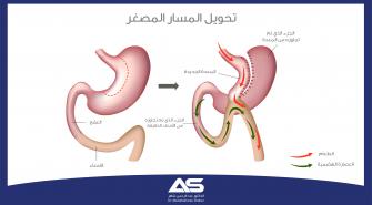 جراحة تحويل المسار المصغّرة Mini Gastric Bypass  وصف العملية والتعافي بعد الجراحة