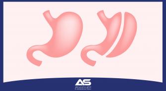 توصيات ونصائح حول عملية تكميم المعدة  Sleeve Gastrectomy